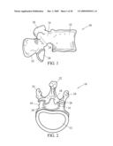 System and Method for Replacement of Spinal Motion Segment diagram and image