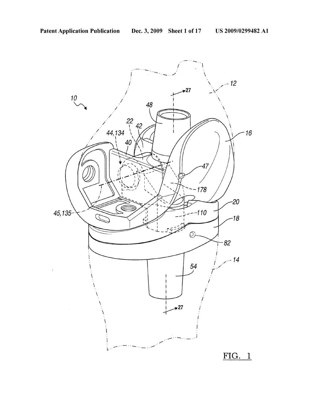 Knee Joint Prosthesis System and Method for Implantation - diagram, schematic, and image 02