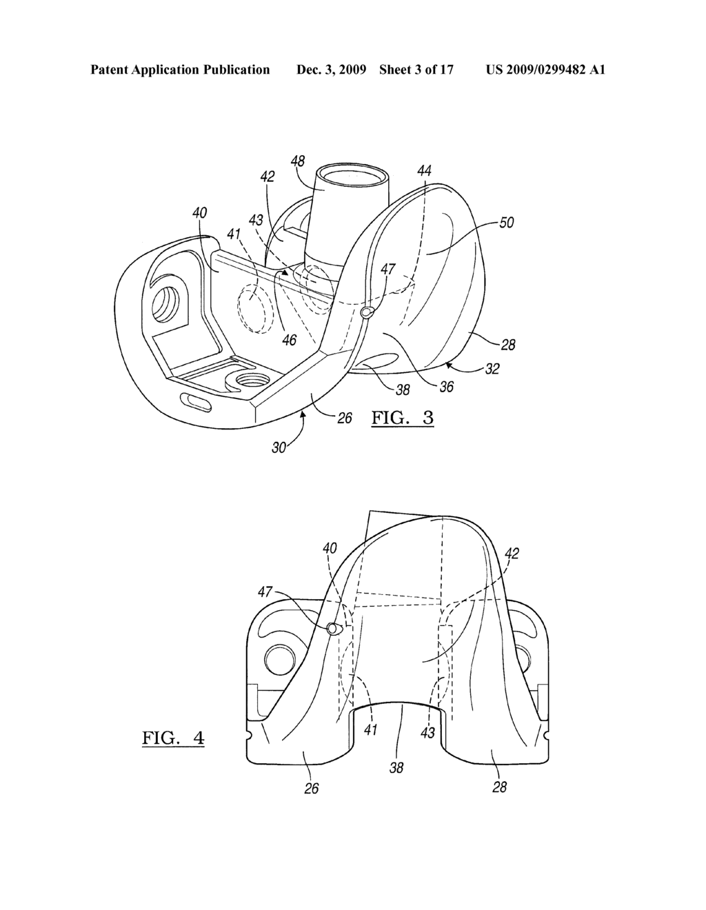 Knee Joint Prosthesis System and Method for Implantation - diagram, schematic, and image 04