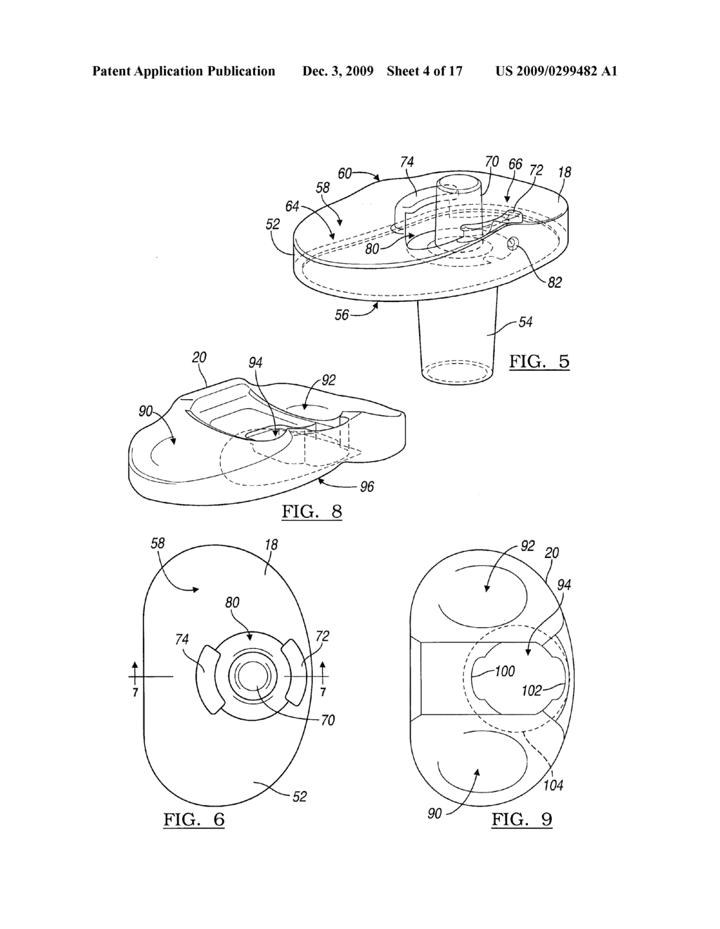 Knee Joint Prosthesis System and Method for Implantation - diagram, schematic, and image 05