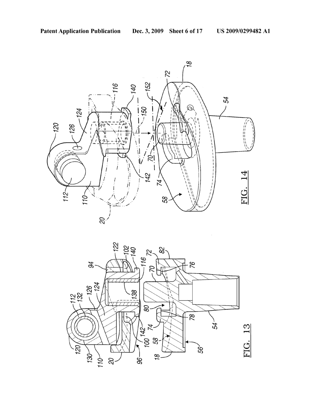 Knee Joint Prosthesis System and Method for Implantation - diagram, schematic, and image 07