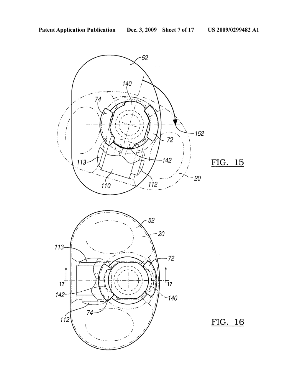 Knee Joint Prosthesis System and Method for Implantation - diagram, schematic, and image 08