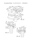 Knee Joint Prosthesis System and Method for Implantation diagram and image