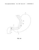 SATIATION DEVICES AND METHODS diagram and image