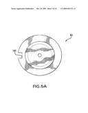 Laser Alignment device comprising plunger diagram and image