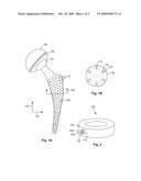 Drug-Exuding Orthopedic Implant diagram and image