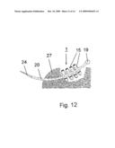 Implant for Treating the Internal Walls of a Resection Cavity diagram and image