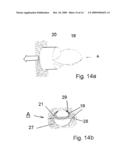 Implant for Treating the Internal Walls of a Resection Cavity diagram and image