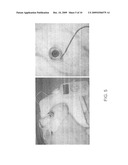 DELIVERY OF CORTICOSTEROIDS THROUGH IONTOPHORESIS diagram and image