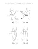 LATERALLY-EXPANDABLE ACCESS CANNULA FOR ACCESSING THE INTERIOR OF A HIP JOINT diagram and image