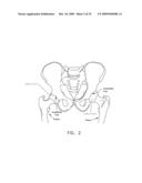 LATERALLY-EXPANDABLE ACCESS CANNULA FOR ACCESSING THE INTERIOR OF A HIP JOINT diagram and image