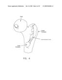 LATERALLY-EXPANDABLE ACCESS CANNULA FOR ACCESSING THE INTERIOR OF A HIP JOINT diagram and image