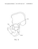 LATERALLY-EXPANDABLE ACCESS CANNULA FOR ACCESSING THE INTERIOR OF A HIP JOINT diagram and image