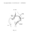 LATERALLY-EXPANDABLE ACCESS CANNULA FOR ACCESSING THE INTERIOR OF A HIP JOINT diagram and image