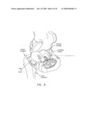 LATERALLY-EXPANDABLE ACCESS CANNULA FOR ACCESSING THE INTERIOR OF A HIP JOINT diagram and image