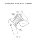 LATERALLY-EXPANDABLE ACCESS CANNULA FOR ACCESSING THE INTERIOR OF A HIP JOINT diagram and image