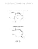 LATERALLY-EXPANDABLE ACCESS CANNULA FOR ACCESSING THE INTERIOR OF A HIP JOINT diagram and image