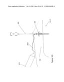 INFLATABLE MEDICAL DEVICES diagram and image