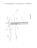 INFLATABLE MEDICAL DEVICES diagram and image