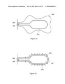 INFLATABLE MEDICAL DEVICES diagram and image