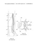 INFLATABLE MEDICAL DEVICES diagram and image