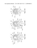 INFLATABLE MEDICAL DEVICES diagram and image