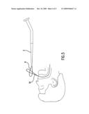 UNIVERSAL PERCUTANEOUS ENDOSCOPIC GASTROSTOMY TUBE diagram and image