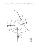 Therapy apparatus for thermal sclerosing of body tissue diagram and image