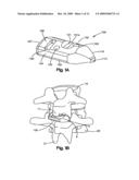 INTERSPINOUS PROCESS SPACER diagram and image