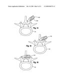 INTERSPINOUS PROCESS SPACER diagram and image