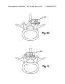 INTERSPINOUS PROCESS SPACER diagram and image