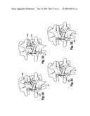 INTERSPINOUS PROCESS SPACER diagram and image