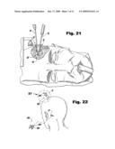 Surgical Access Methods For Use With Delicate Tissues diagram and image