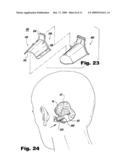 Surgical Access Methods For Use With Delicate Tissues diagram and image