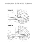 Surgical Access Methods For Use With Delicate Tissues diagram and image