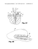 Surgical Access Methods For Use With Delicate Tissues diagram and image