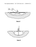 Wound treatment apparatus and method diagram and image