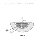 Wound treatment apparatus and method diagram and image