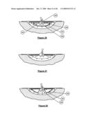 Wound treatment apparatus and method diagram and image