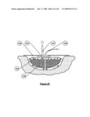 Wound treatment apparatus and method diagram and image