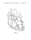 Perivascular Leak Repair System diagram and image