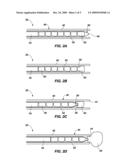 DEVICE, SYSTEM AND METHOD FOR ANEURYSM EMBOLIZATION diagram and image