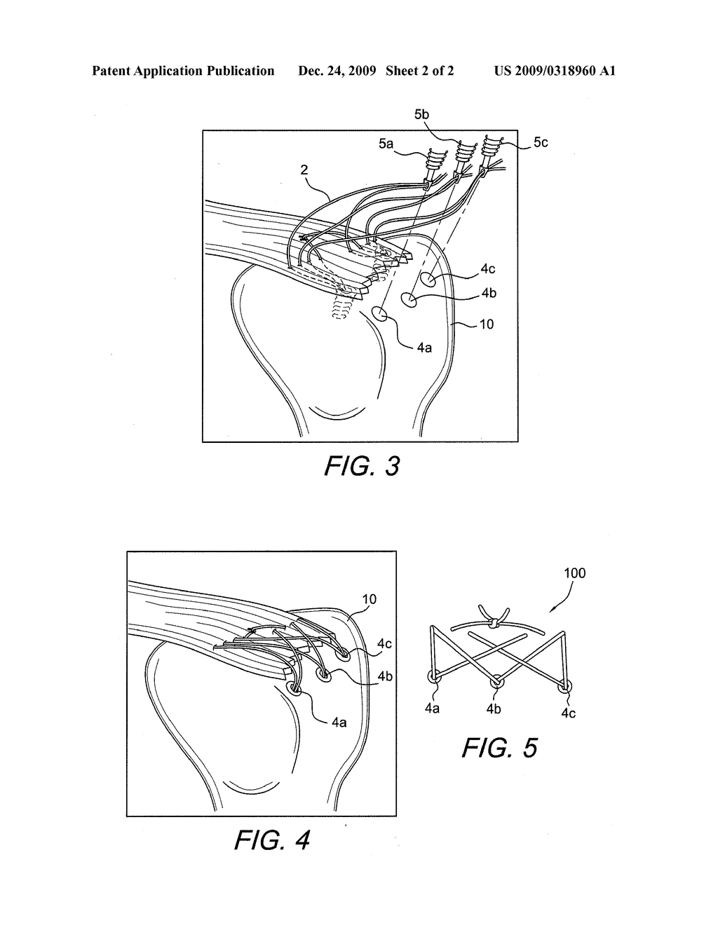 METHOD OF KNOTLESS TISSUE FIXATION WITH CRISS-CROSS SUTURE PATTERN - diagram, schematic, and image 03