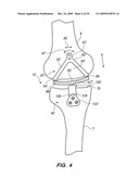 IMPLANTABLE BRACE FOR PROVIDING JOINT SUPPORT diagram and image