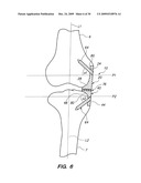 IMPLANTABLE BRACE FOR PROVIDING JOINT SUPPORT diagram and image