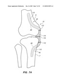 IMPLANTABLE BRACE FOR PROVIDING JOINT SUPPORT diagram and image