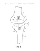 IMPLANTABLE BRACE FOR PROVIDING JOINT SUPPORT diagram and image