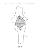 IMPLANTABLE BRACE FOR PROVIDING JOINT SUPPORT diagram and image