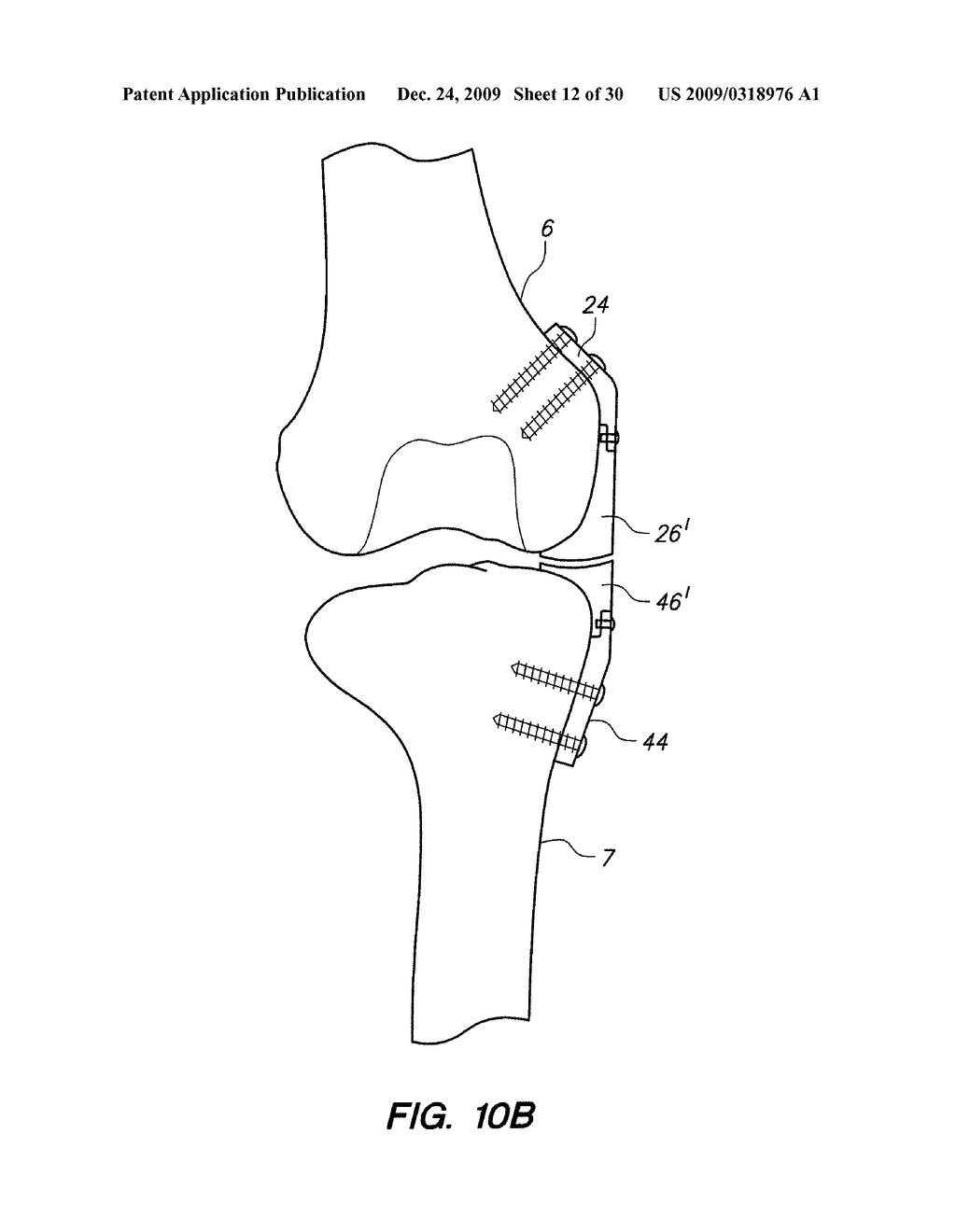 IMPLANTABLE BRACE FOR PROVIDING JOINT SUPPORT - diagram, schematic, and image 13