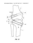 IMPLANTABLE BRACE FOR PROVIDING JOINT SUPPORT diagram and image